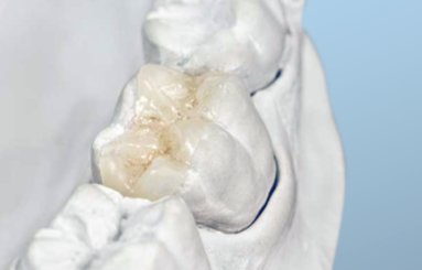 Вкладка становится органичным продолжением зуба